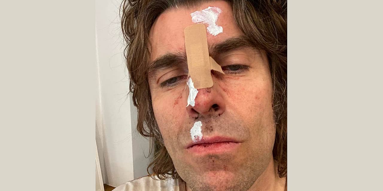 Liam Gallagher Injured After Falling Out of a Helicopter