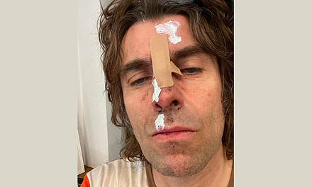 Liam Gallagher Injured After Falling Out of a Helicopter